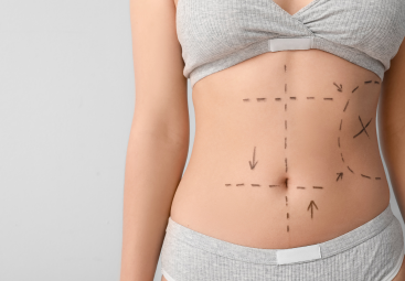 Více než liposukce: Liposkulptura formuje tělo a vykouzlí svaly